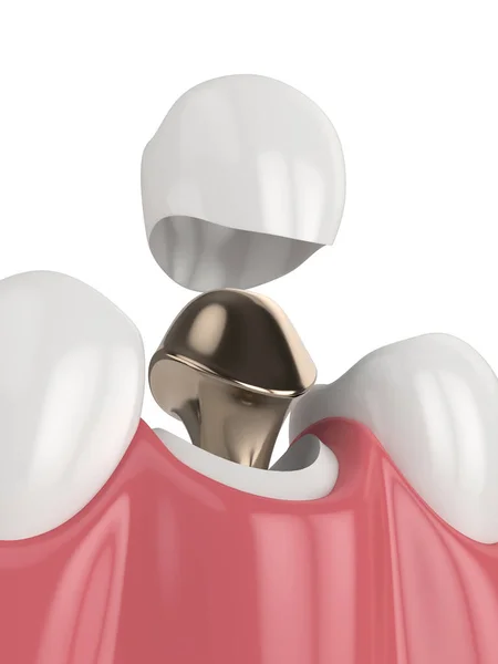 3Dレンダリングの下顎キャストポストとコア歯の復元白の背景に — ストック写真
