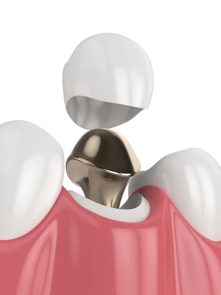 Render Lower Jaw Cast Post Core Tooth Restoration White Background — Stock Photo, Image