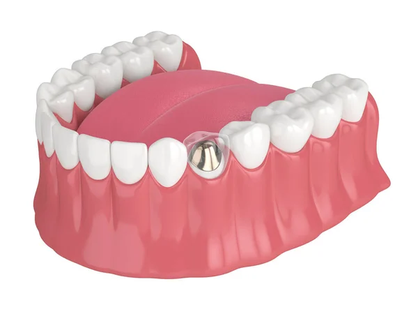 Render Lower Jaw Cast Post Core Tooth Restoration White Background — Stock Photo, Image