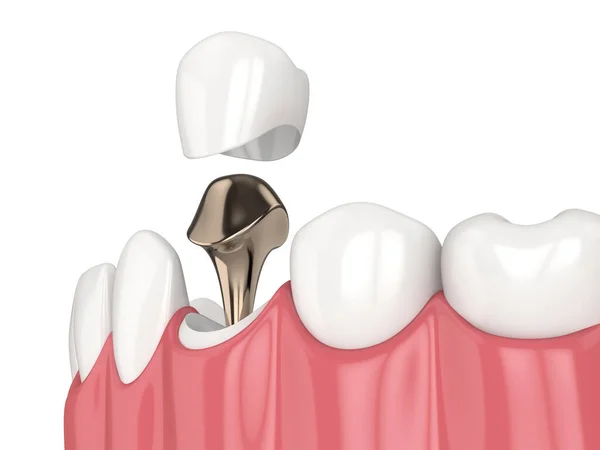 Renderowanie Dolnej Szczęki Odlewanym Słupkiem Przywrócenie Zęba Rdzenia Białym Tle — Zdjęcie stockowe