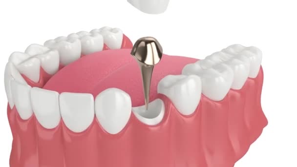 Lower Jaw Cast Post Core Premolar Tooth Restoration White Background — Stock Video