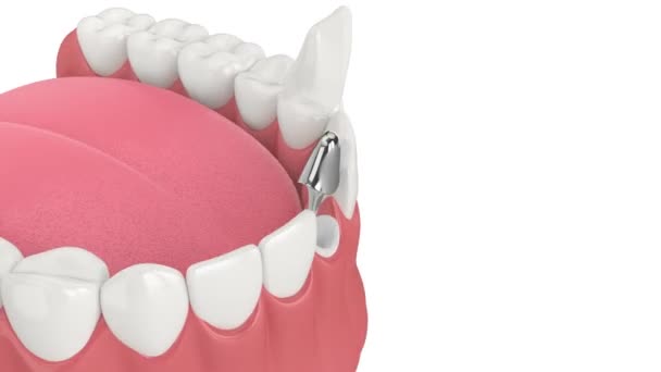Dolna Szczęka Odlewanym Słupkiem Odbudową Zęba Siekacza Rdzenia Białym Tle — Wideo stockowe