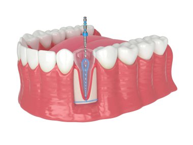 Beyaz arkaplan üzerinde endodontik yuvarlak dosya ile alt çene 3d görüntüleme. Endodontik tedavi kavramı. 