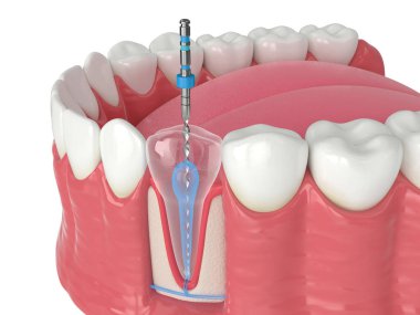 Beyaz arkaplan üzerinde endodontik yuvarlak dosya ile alt çene 3d görüntüleme. Endodontik tedavi kavramı. 