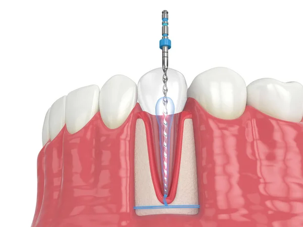 stock image 3d render of lower jaw with endodontic rotary file over white background. Endodontic treatment concept. 