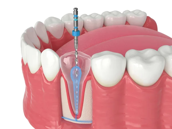 Render Lower Jaw Endodontic Rotary File White Background Endodontic Treatment — Stock Photo, Image