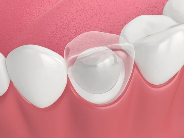 Renderização Mandíbula Inferior Com Poste Dental Restauração Dente Núcleo Sobre — Fotografia de Stock