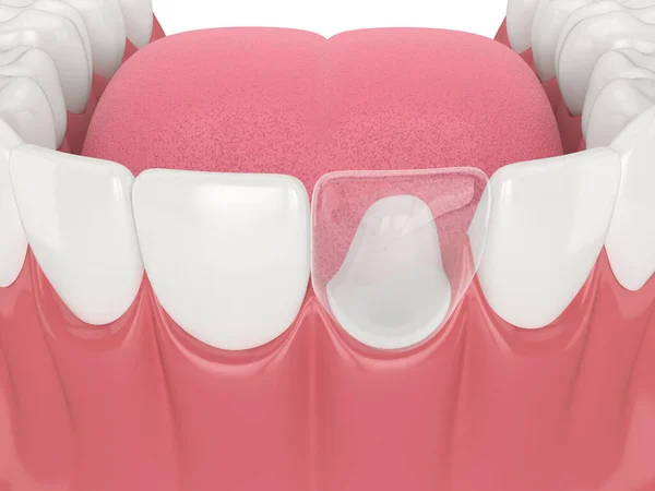 Renderização Mandíbula Inferior Com Restauração Dentes Post Core Sobre Fundo — Fotografia de Stock