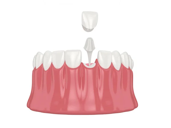 3Dレンダリングの下顎に審美的なポストと白い背景の上にコア歯の復元 — ストック写真