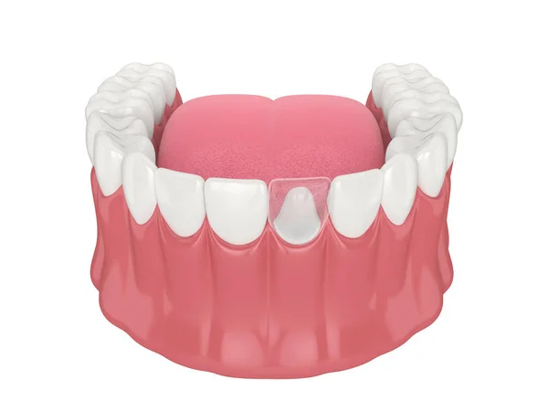 Render Lower Jaw Dental Post Core Tooth Restoration White Background — Stock Photo, Image