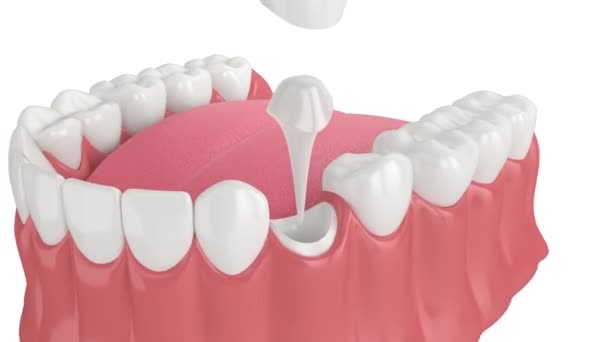 Dolna Szczęka Odlewanym Słupkiem Odbudową Zęba Siekacza Rdzenia Białym Tle — Wideo stockowe
