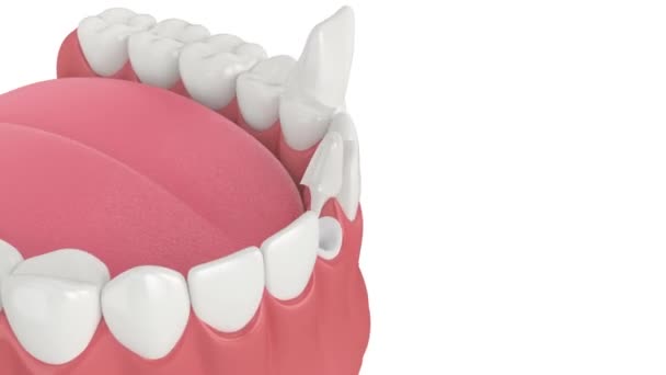 Mandíbula Inferior Com Restauração Dentes Incisivos Pós Core Sobre Fundo — Vídeo de Stock