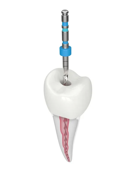 stock image 3d render of premolar tooth with endodontic rotary file over white background. Endodontic treatment concept. 