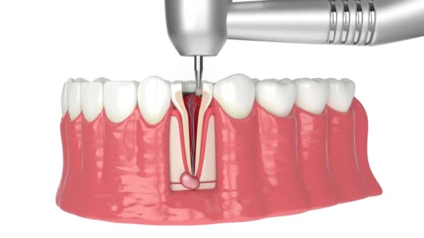 歯根管治療手順と下顎 — ストック動画