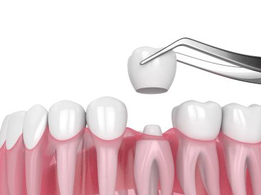 Yeniden şekillendirilmiş dişe 3 boyutlu taç yerleştirme