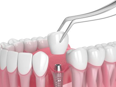 Beyaz arkaplan üzerine diş implantı yerleştirilmiş 3d çene oluşturma