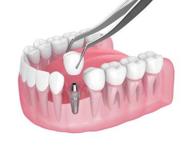 Beyaz arkaplan üzerine diş implantı yerleştirilmiş 3d çene oluşturma