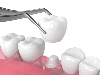 Yeniden şekillendirilmiş dişe 3 boyutlu taç yerleştirme
