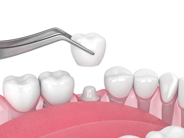 Render Crown Replacement Reshaped Tooth — Stock Photo, Image