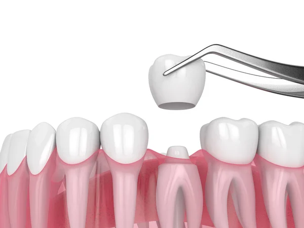Render Crown Replacement Reshaped Tooth — Stock Photo, Image