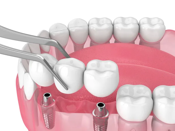 Beyaz Arkaplan Üzerinde Diş Köprüsü Destekleyen Implantlı Çene — Stok fotoğraf