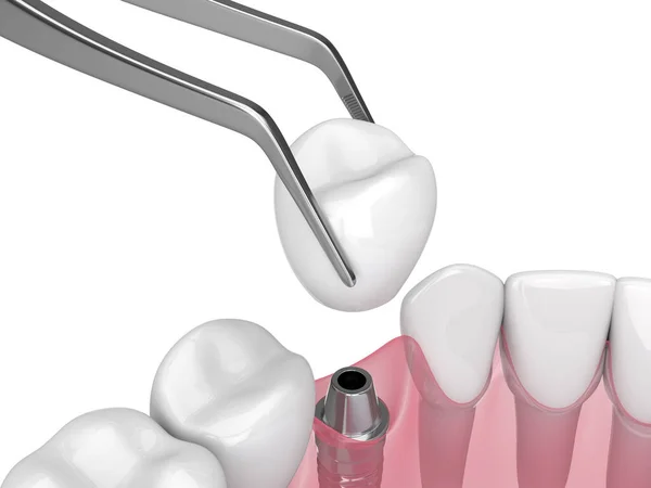 Weergave Van Kaak Met Tandheelkundig Implantaat Plaatsing Witte Achtergrond — Stockfoto