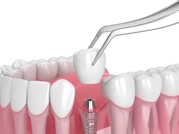 Render Jaw Dental Implant Placement White Background — Stock Photo, Image