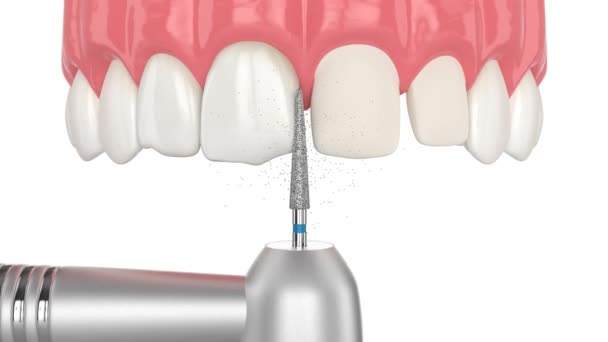 Процедура Розміщення Вінірів Відновлення Пошкоджених Зубів — стокове відео