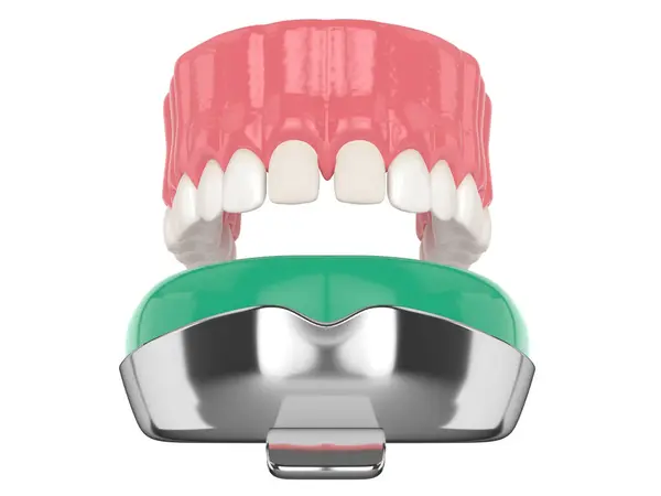 Rendering Della Mascella Superiore Con Vassoio Impressione Dentale Sfondo Bianco Foto Stock Royalty Free
