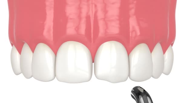 Traitement Des Dents Tordues Par Collage Résine Composite — Video