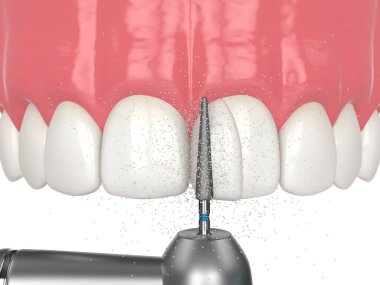 Bağlanma prosedürünü kullanarak diastema 'nın 3 boyutlu olarak kapatılması. Yedinci bölüm. Dişe şekil vermek ve fazla reçineyi çıkarmak için dişçi matkabı kullanmış. Diastema prosedür kavramı kapatılıyor.