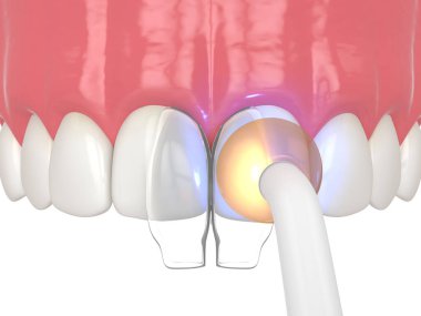 3d render of diastema closure using bonding procedure. Part 6. Hardening composite resin with a curing light. Closing diastema procedure concept. clipart