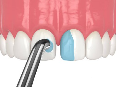 Bağlanma prosedürünü kullanarak diastema 'nın 3 boyutlu olarak kapatılması. Bölüm 3. Hafif asidi kaldırıyorum. Diastema prosedür kavramı kapatılıyor.
