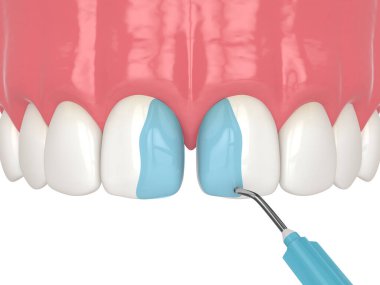 Bağlanma prosedürünü kullanarak diastema 'nın 3 boyutlu olarak kapatılması. Bölüm 2. Diş minesini hafif bir asitle boyuyorum. Diastema prosedür kavramı kapatılıyor.
