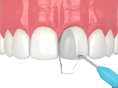 Eğri diş tedavisiyle bağlanma prosedürü kullanılarak yapılan 3 boyutlu işlem