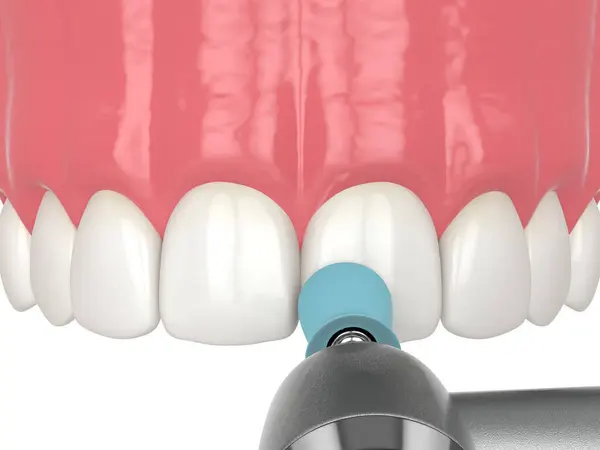 Renderização Fechamento Diastema Usando Procedimento Colagem Parte Dente Polimento Por Imagens Royalty-Free