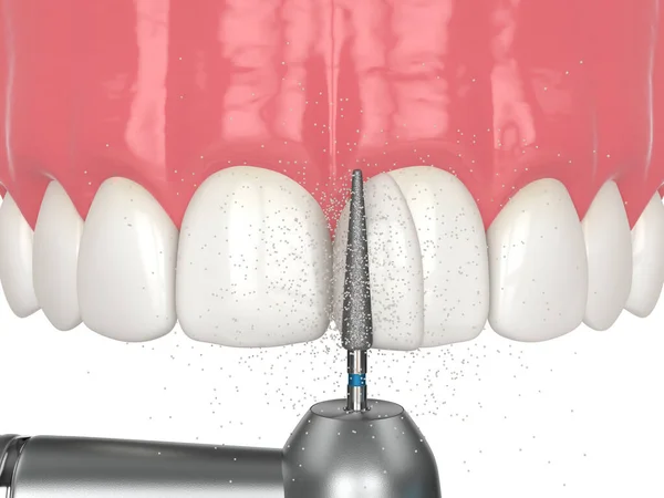 結合手順を使用したダイアスタマ閉鎖の3Dレンダリング パート7 歯科ドリルを使用して歯を形作り 余分な樹脂を取り除きます ダイアスタマ手順のコンセプトを閉じる ロイヤリティフリーのストック写真