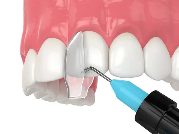 Eğri Diş Tedavisiyle Bağlanma Prosedürü Kullanılarak Yapılan Boyutlu Işlem Stok Fotoğraf