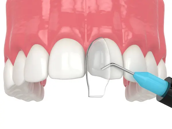 結合プロシージャを使用して曲げられた歯の処置の3Dレンダリング ロイヤリティフリーのストック写真