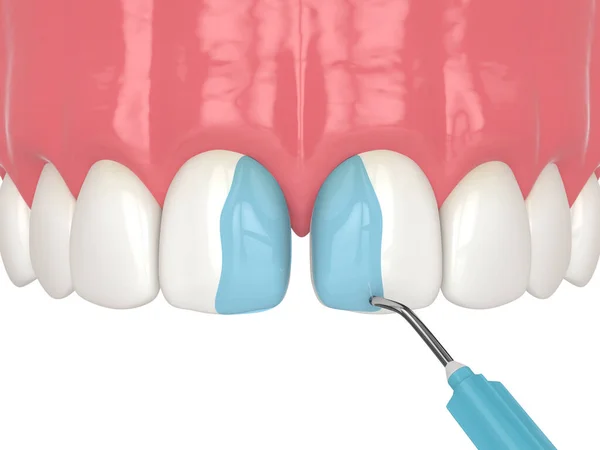 Bağlanma Prosedürünü Kullanarak Diastema Nın Boyutlu Olarak Kapatılması Bölüm Diş Stok Fotoğraf
