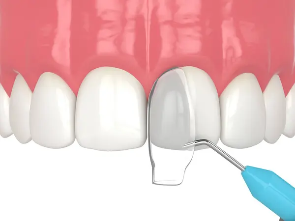 Render Crooked Tooth Treatment Using Bonding Procedure Stock Image