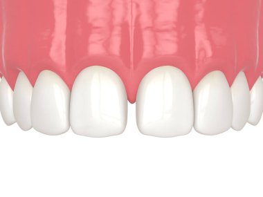 Bağlanma prosedürünü kullanarak diastema 'nın 3 boyutlu olarak kapatılması. Bölüm 1. Diastema. Diastema prosedür kavramı kapatılıyor.