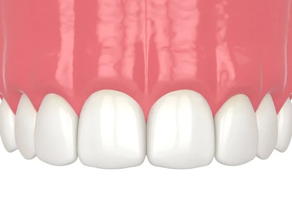 結合手順を使用したダイアスタマ閉鎖の3Dレンダリング 第9部 結合手順によって回復する歯の最終結果 ダイアスタマ手順のコンセプトを閉じる ストックフォト