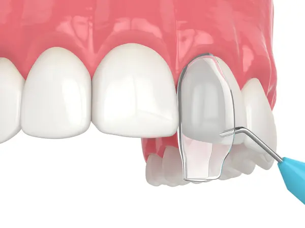 Vykreslení Křivolaké Úpravy Zubů Pomocí Postupu Lepení Royalty Free Stock Fotografie