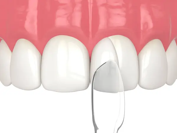 ホワイト上に複合樹脂アントマトリックスによって再構成された歯の3Dレンダリング クロックされた歯の再構築の概念 ストック画像