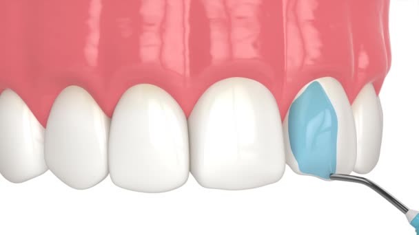 Лікування Кривих Зубів Допомогою Процедури Склеювання Композитною Смолою — стокове відео