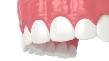 Üst çene yapışkan gülümseme için lazerle işlenmiş. Dişeti ameliyatı ile yeni bir sakız çizgisi oluşturuluyor.