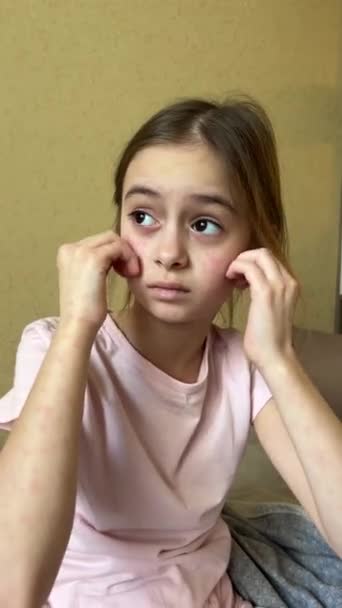 Страждання Від Алергії Дошкільна Дівчина Дряпає Шкіру Вдома Підліток Курячими — стокове відео
