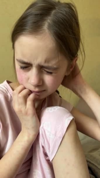 Страждання Від Алергії Дошкільна Дівчина Дряпає Шкіру Вдома Підліток Курячими Стоковий Відеоролик