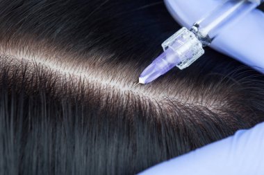 Mezoterapi prosedürü. Doktor kozmetik uzmanı kadının kafasındaki mesoterapi prosedürünü uyguluyor. Saçlarını güçlendir ve büyümelerini sağla..